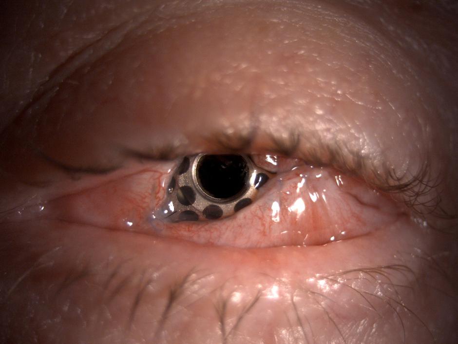 operacija zenice | Avtor: UKCLJ