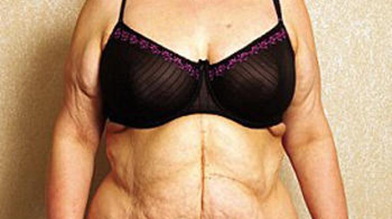 Malissa žaluje za izgubljenimi kilogrami. (Foto: Daily Mail)