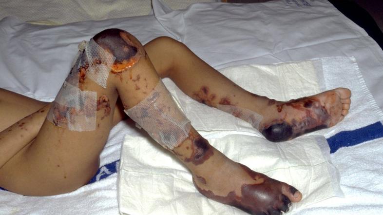 meningokokni meningitiso tipa B