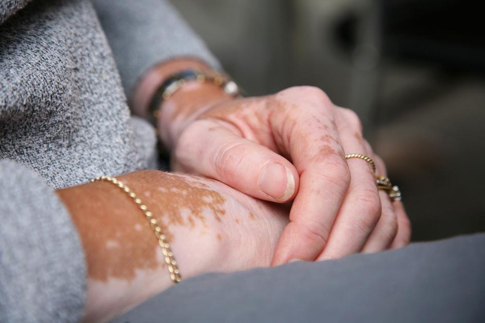 vitiligo, kožna bolezen, depigmentacija, bele lise